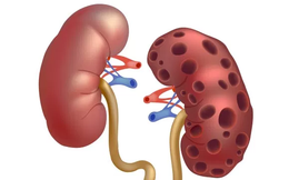 Chấn thương thận - Hình ảnh minh họa